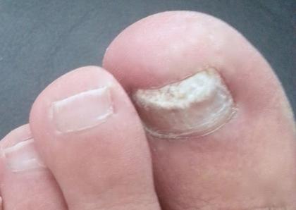 Beschädigter durch Nagelpilz Fußnagel in 15 Min. mit dem Fußnagel Spray/Jenn Cos