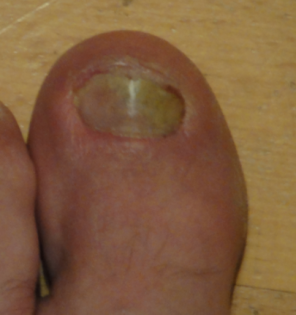 Nagelpilz Spuren am Nagel in 15 Min. mit dem Fußnagelspray von Jenn Cosmetic weg
